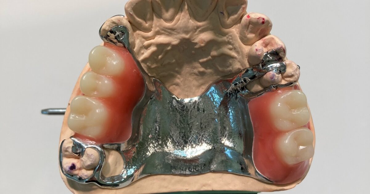 金属床義歯を製作しました！🦷 | お知らせ・ブログ | 熊本歯科